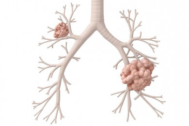 Bekanntes Krebs-Gen hilft gegen Lungenkrebs