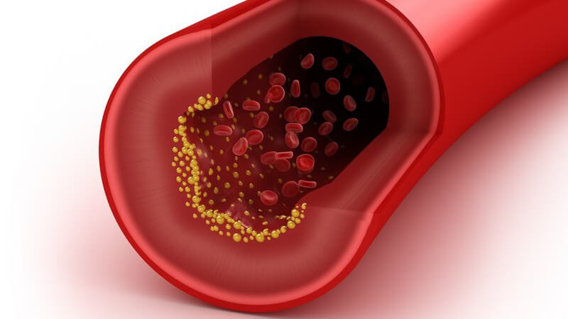 Querschnitt Arterie, Blutcholesterin, erhöhter Cholesterinwert