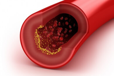 Therapie für Cholesterin-Patienten: PCSK9-Inhibitoren als Alternative zu Statinen?