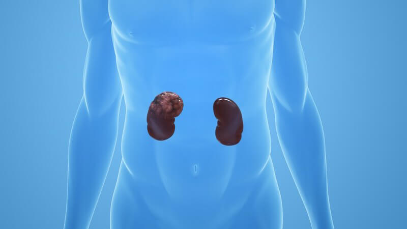 Grafik der menschlichen Nieren mit Nierenkrebs