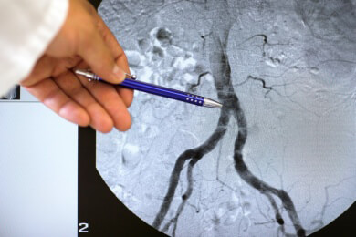 Bei Mehrgefäßerkrankung ist Bypass besser als ein Stent