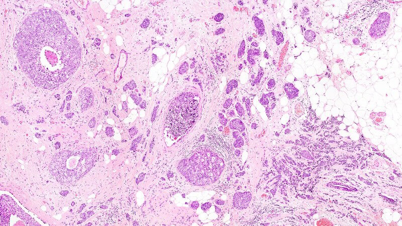Mikroskopisches Bild Brustkrebs