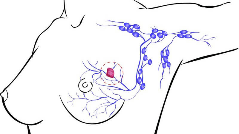 Zeichnung weibliche Brust mit Krebs