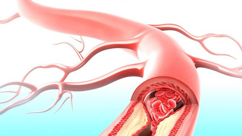 Grafik Arterie mit Verengung - Arteriosklerose