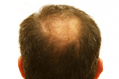 Neue Hilfe bei früher Glatze: Auszupfen der Haare lässt neue sprießen