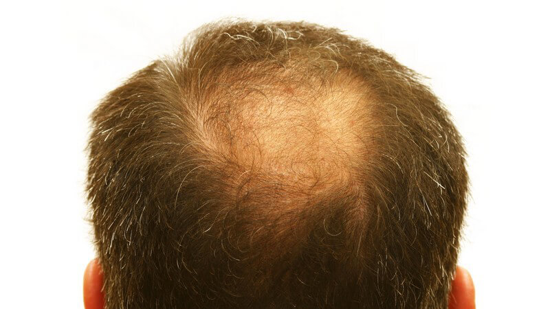 Hinterkopf eines dunkelhaarigen Mannes mit lichtem Haar und anfänglicher Glatze