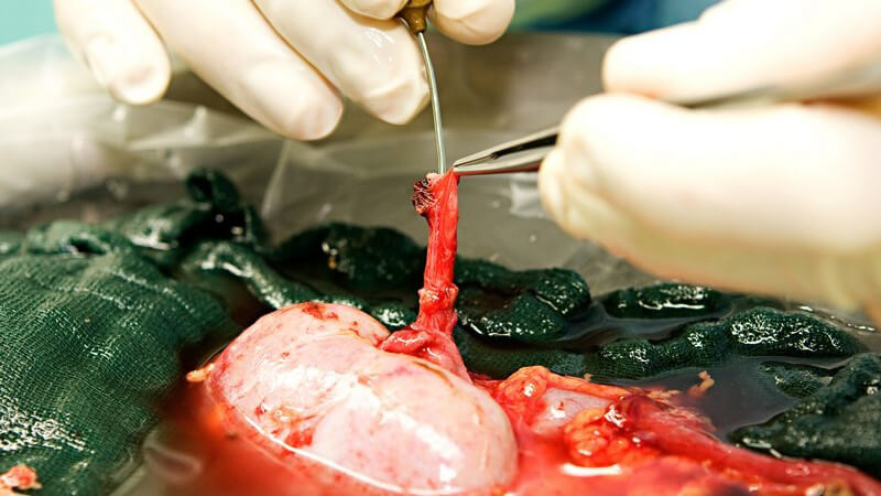 Hände eines Arztes bei Nierentransplantation