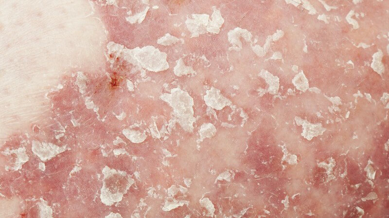 Hautausschnitt mit Schuppenflechte (Psoriasis vulgaris)