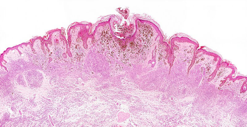 Mikroskopbild rosafarbig, bösartiges Melanom