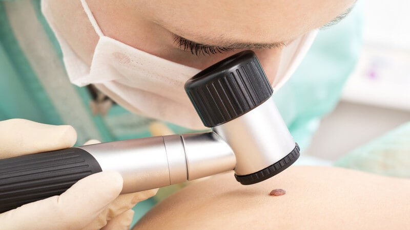 Hautkrebsvorsorge - Hautärztin oder Chirurgin untersucht Muttermal mit Dermatoskop