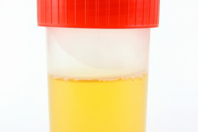 Risiko für einen Herzinfarkt lässt sich im Urin erkennen