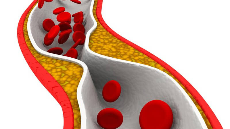 Grafik Arterie mit Blutplättchen und Verengung: Arteriosklerose