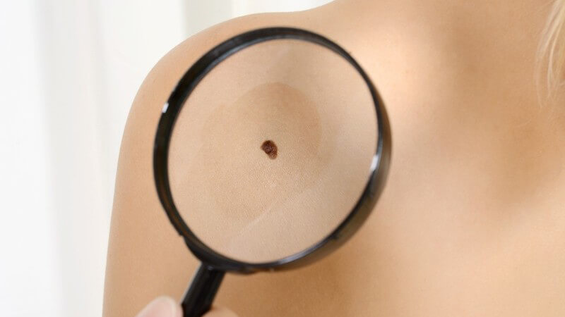Lupe auf Muttermal auf dem Rücken einer Frau - Hautkrebs-Screening beim Hautarzt