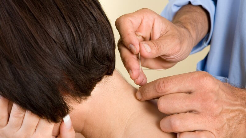 Nahaufnahme junge Frau wird im Nacken akupunktiert