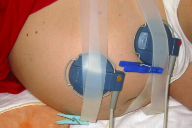 Studie zum vorzeitigen Blasensprung: Wie handeln, wenn die Fruchtblase zu früh platzt?