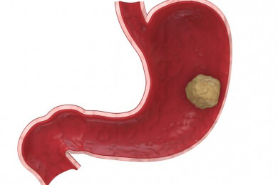 Risiko für den Krebstod ist nach einer Organtransplantation lebenslang erhöht