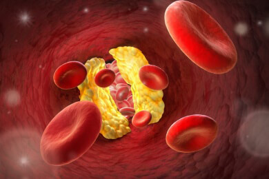 Wird Arterienverkalkung umkehrbar? Nanopartikel gegen Arteriosklerose