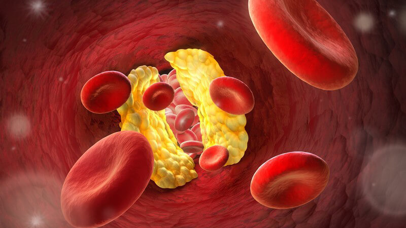 3-D-Grafik mit roten Blutkörperchen, die durch eine Arterie mit einem gelb dargestellten Engpass schweben