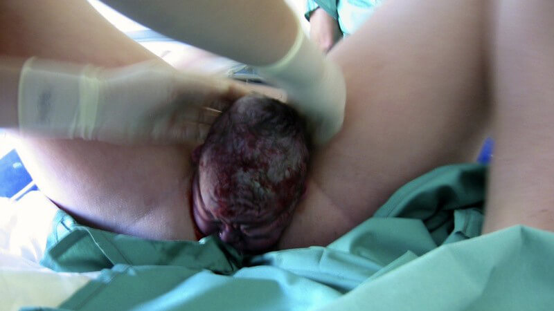 Zwei Hände in Handschuhen holen ein Neugeborenes aus dem Mutterleib