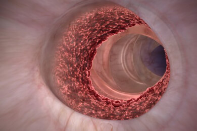 Studie erforscht, warum eine fettige Ernährung zu Darmkrebs führen kann