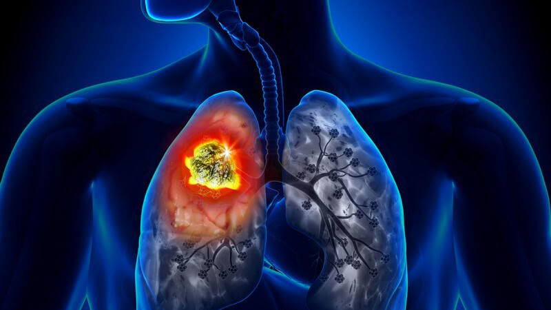 Grafik eines Lungentumors (Lungenkrebs) im Körper eines Mannes, Tumor gelb-rot leuchtend hervorgehoben