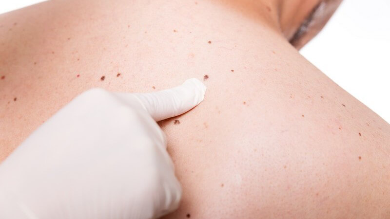 Hautarzt mit Gummihandschuh zeigt mit dem Zeigefinger auf ein Muttermal auf dem Rücken eines Mannes
