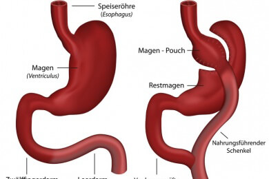 Im Kampf gegen Adipositas: Magenbypass bringt die beste Langzeitwirkung