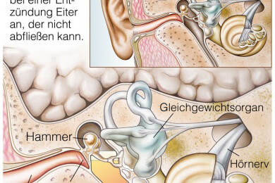 Antibiotika bei einer Mittelohrentzündung: Ersetzt ein Gel das Schlucken von Tabletten?