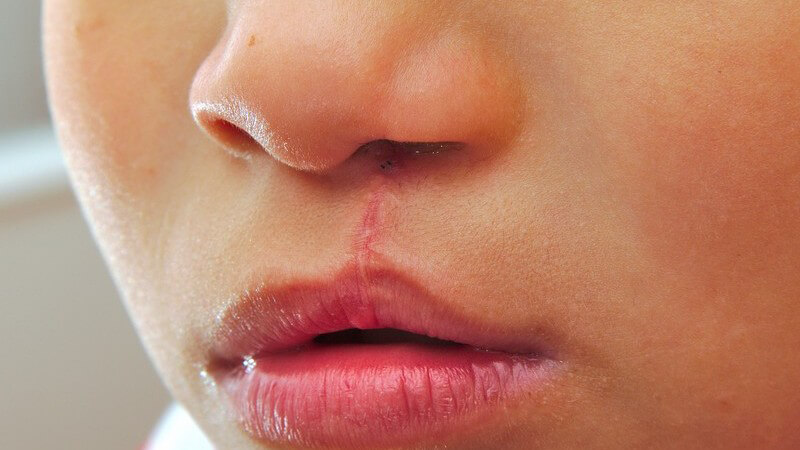 Nahaufnahme des Gesichts eines Jungen mit operierter Lippen-Kiefer-Gaumenspalte