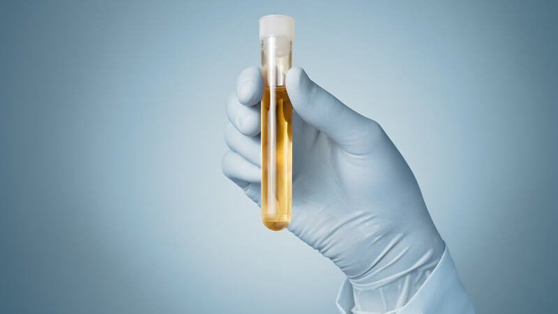 Hand hält eine Urinprobe im Reagenzglas vor blauem Hintergrund