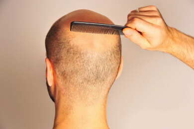 Wen trifft der Haarausfall? Studie ermittelt Körpermerkmale mit höchstem Haarausfall-Risiko