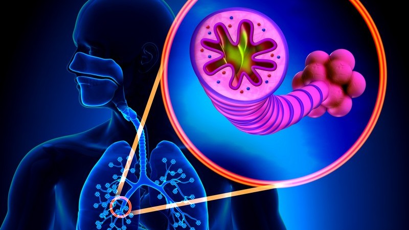 Blaue 3-D-Grafik einer Chronisch obstruktiven Lungenerkrankung (COPD), Lage im Körper und Vergrößerung eines Bronchiolus
