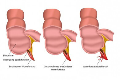 Bei akuter Blinddarmentzündung: Sollten Kinder Antibiotika statt einer OP erhalten?