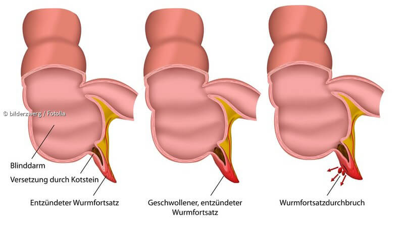 ᐅ Bei akuter Blinddarmentzündung: Sollten Kinder Antibiotika statt einer OP erhalten?