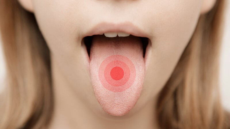 Frau mit ausgestreckter Zunge, auf der Zungenmitte sind rote Markierungsringe eingezeichnet