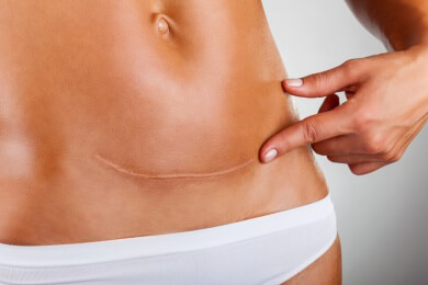 Risiken nach einem Kaiserschnitt: eine Hysterektomie wird gefährlicher