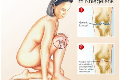 Der richtige Sport ist bei Arthrose wichtig