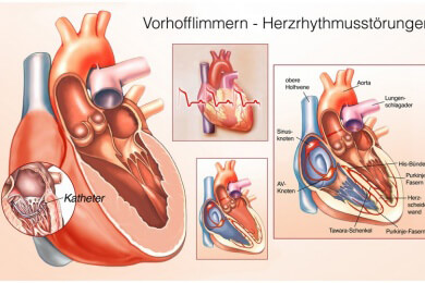 Vorhofflimmern erkennen: implantierter Herzmonitor schlägt Langzeit-EKG