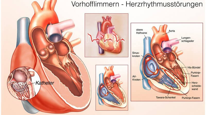 Grafische Darstellung einer Herzrhythmusstörung (Vorhofflimmern), mit Beschriftung