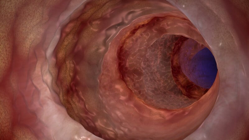 3-D-Grafik der Darmschleimhaut eines Morbus Crohn-Erkrankten