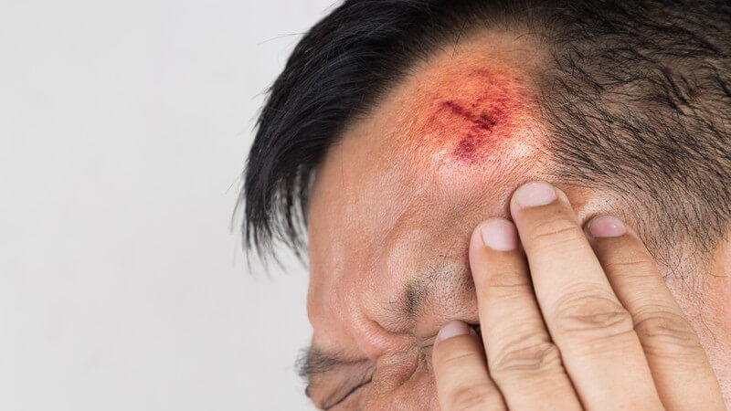 Mann fasst sich an eine schmerzhafte Verletzung an der Stirn, geschwollen und rot