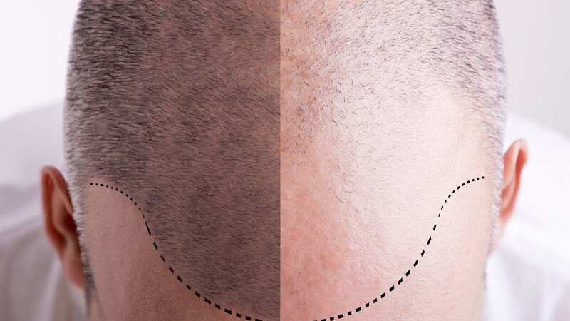 Vergleichsbild eines männlichen Kopfes vor und nach einem Haarausfall
