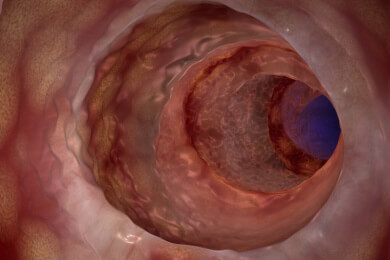 Darmentzündungen wie Colitis ulcerosa und Morbus Crohn können Prostatakrebs begünstigen