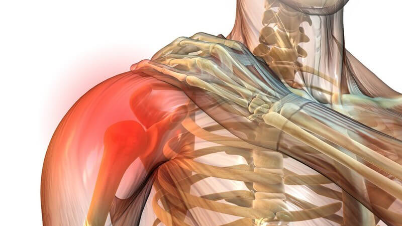 Grafik Körper mit Schulterschmerzen