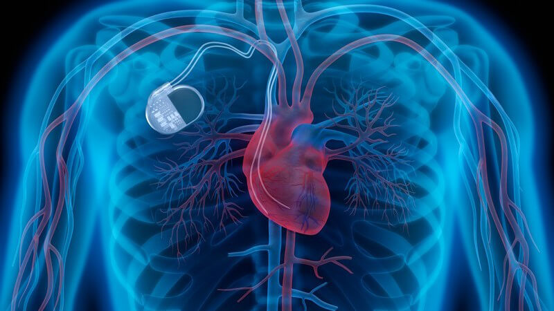 Blaue Röntgengrafik eines Oberkörpers mit rotem Herzen mit angeschlossenem Herzschrittmacher