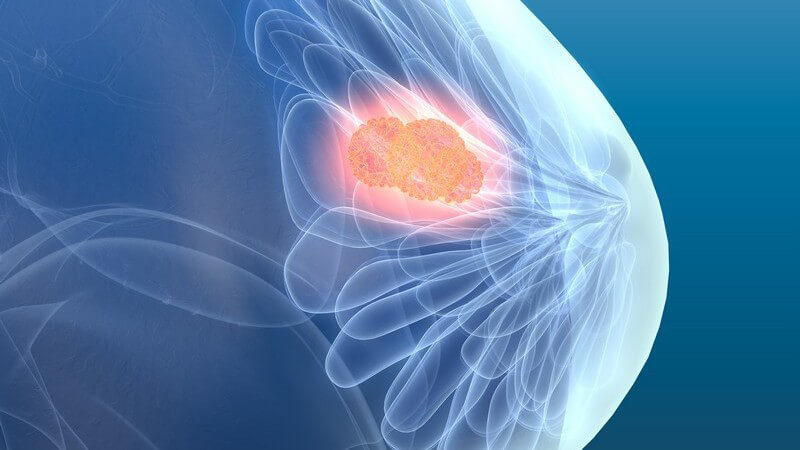 3-D-Grafik mit seitlicher Brustansicht, Tumor rot hervorgehoben (Brustkrebs)