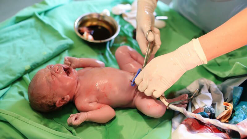 Neugeborenes liegt im Krankenhaus auf einem grünen Tuch und schreit während die Nabelschnur abgeschnitten wird