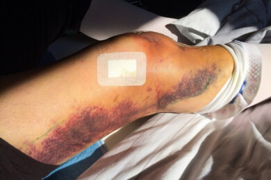 Künstliche Gelenke geben Metallpartikel an Knochen ab