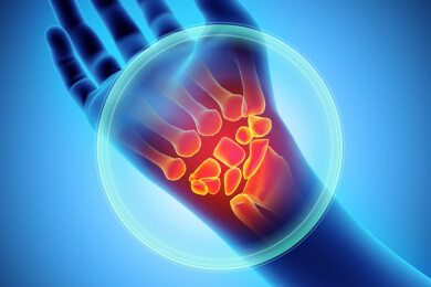 Knochenbruch im Handgelenk: Unkomplizierte Brüche im Kahnbein müssen selten operiert werden