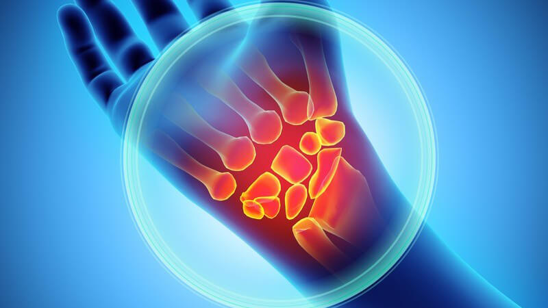 Blaue 3-D-Grafik des Unterarms mit Schmerzen im Handgelenk, Handgelenkknochen rot hervorgehoben und eingekreist